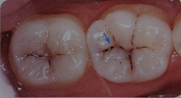 奥歯の溝が黒い 治療が必要ですか 八潮駅前通り歯科医院 埼玉県八潮市の歯医者