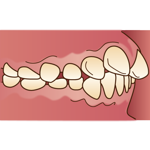 指しゃぶりが原因で起きる歯並びの乱れのサイン 八潮駅前通り歯科医院 埼玉県八潮市の歯医者